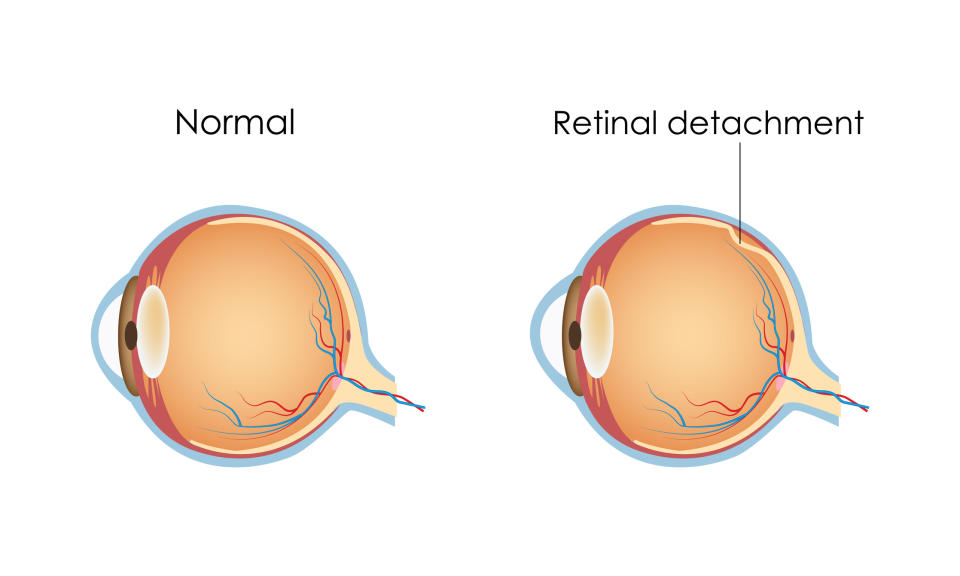 Two diagrams of an eye: the left shows a normal eye, and the right shows an eye with retinal detachment indicated by an arrow