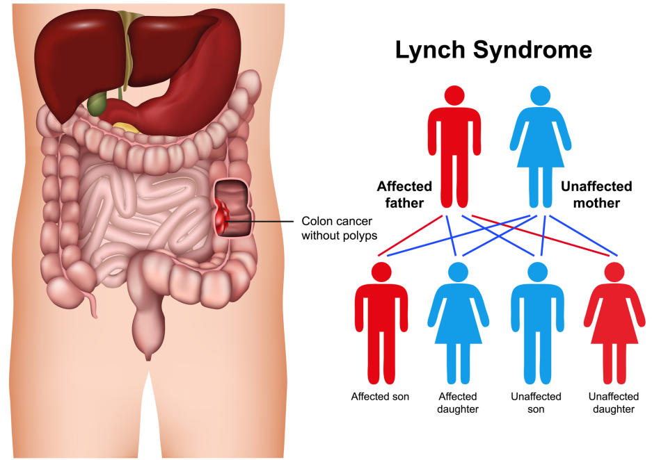 Medical illustration explaining Lynch Syndrome inheritance patterns, showing affected and unaffected family members, with focus on colon cancer without polyps