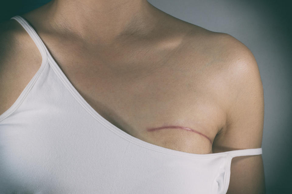 Person wearing an off-shoulder top showing a scar, visible across the upper chest area. No text is present